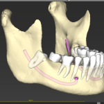 N. 24 – 🦷 Dente del giudizio: quando preoccuparsi, cosa fare e quando va davvero tolto